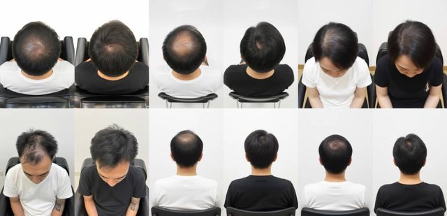 Collage of before and after hair growth results from Folli-Activ customers in Malaysia